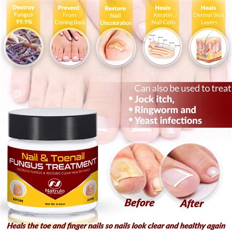 Natrulo Nail And Toenail Treatment Herbal Nail Cream With Tolnaftate