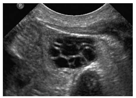 Normal Newborn Ovary Transabdominal Ultrasound Image Reveals Multiple