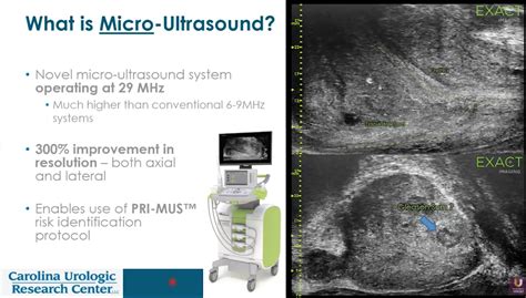 Micro Ultrasound System For Improving Transrectal Prostate Biopsy