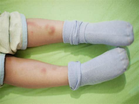 Leukemia Bruising In Children