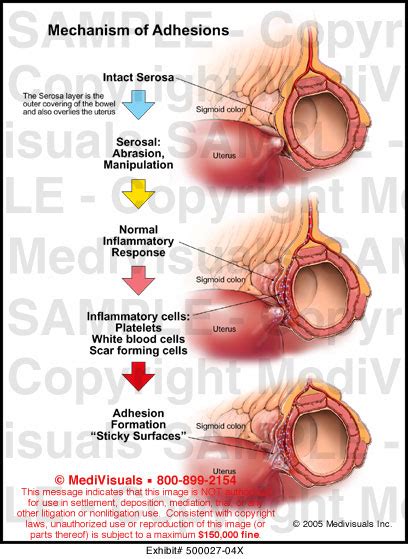 Mechanism Of Adhesions Medical Illustration