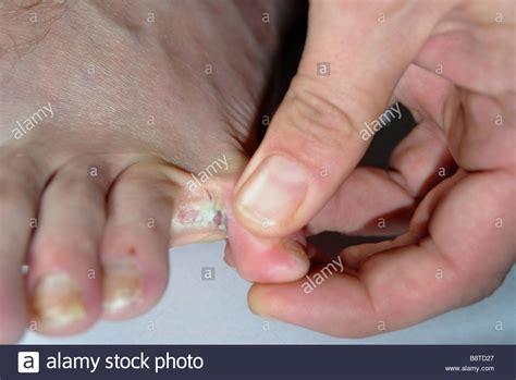 Close Up Athletes Foot Fungal Infection Stock Photo 22664719 Alamy