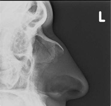 Closed loop in small bowel obstruction. Nasal Bone Fracture- Grey Zone - Sumer's Radiology Blog