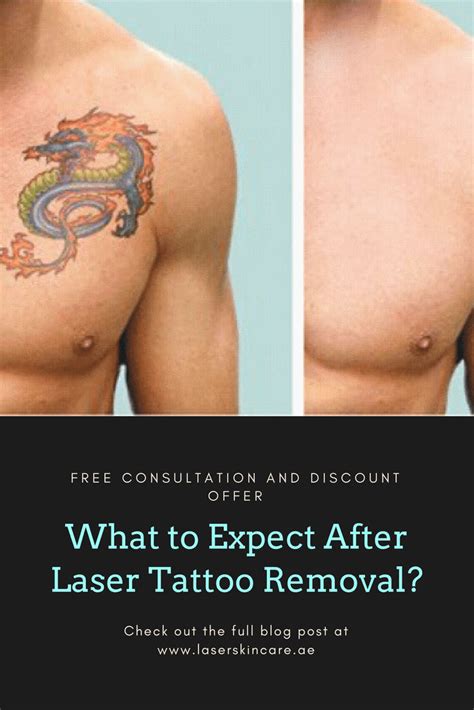 What To Expect After Laser Tattoo Removal Laser Skin Care