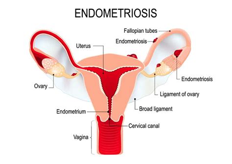 endometriosis si tienes estos síntomas puedes estar sufriéndola zenzsual