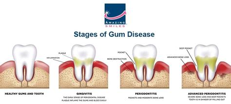 What Is Gingivitis Symptoms Prevention And Treatment Options
