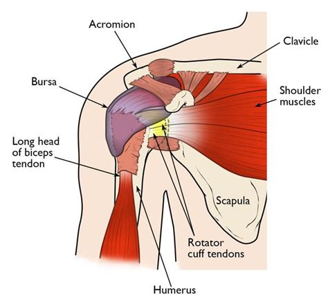 In sub acromial impingement the subacriomial space lessens when the shoulder is elevated and therefore pinches the rotator cuff tendons, irritating them and possibly leading to a short muscles can contribute to shoulder impingement by pulling the acromion down and lessening the acromial space. Shoulder Pain Treatment: Can Chiropractors Help? [YES ...