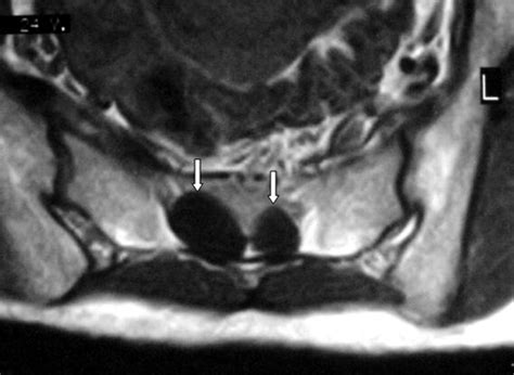 Mri Of Lumbosacral Spine An Axial T1weighted View Shows Two Cystic