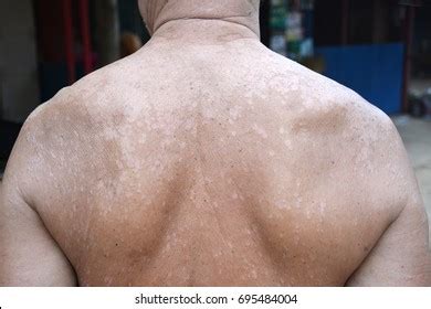 Tinea Versicolorpityriasis Versicolor On Skin Stock Photo Shutterstock
