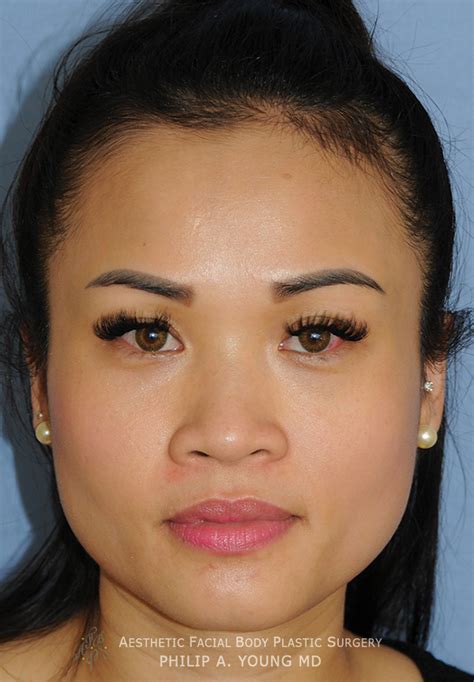Asian Rhinoplasty Before And After Photos Seattle Bellevue