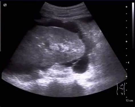 Нефротический синдром диета УЗИ. Асцит и нефротический синдром. | Портал радиологов УЗИ. Асцит и нефротический синдром. | Портал радиологов Нефротический синдром диета