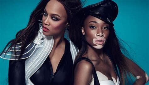Watch Americas Next Top Model Contestant With Vitiligo