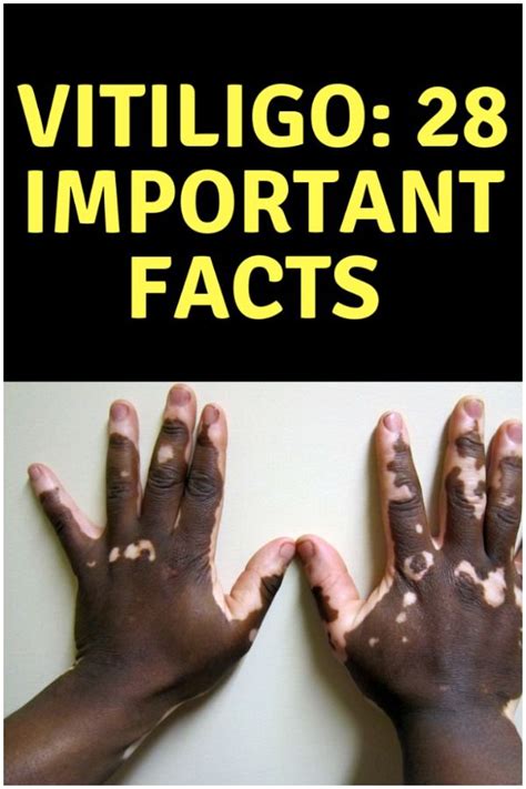 Vitiligo 10 Important Facts Vitiligo Important Facts Facts