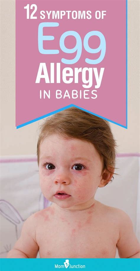 12 Symptoms Of Egg Allergy In Babies And Their Treatment Egg Allergy