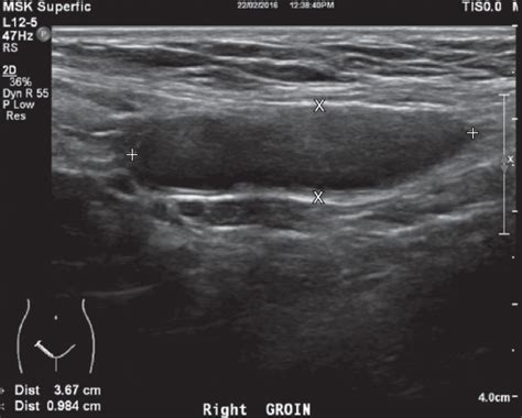 Also the groin nodes swell if there is a. Clinics in diagnostic imaging (183) | SMJ