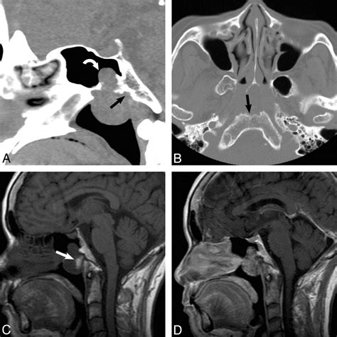 Extraosseous Chordoma Of The Nasopharynx American Journal Of