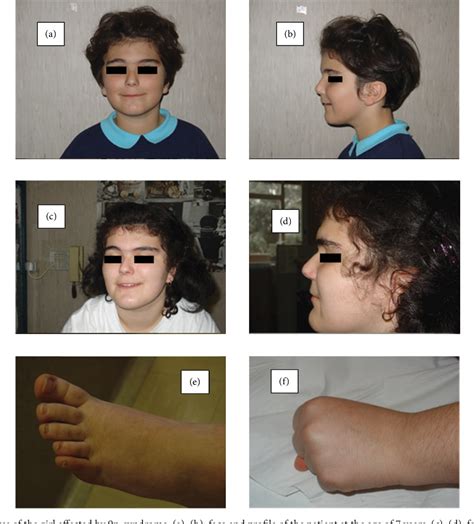 Figure From Idiopathic Central Precocious Puberty Associated With Mb De Novo Distal