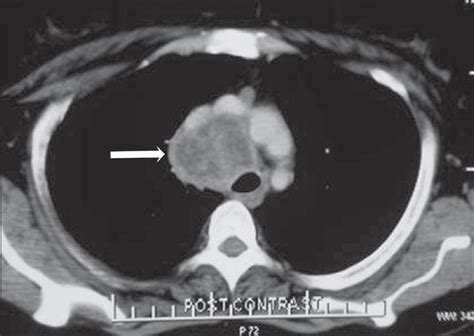 Swollen Lymph Nodes Near Ear Under Jawchin In Neck Armpits Groin