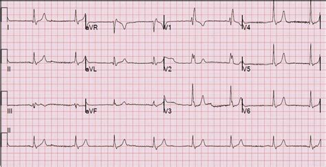 Dr Smith S ECG Blog Is This A Simple Right Bundle Branch Block