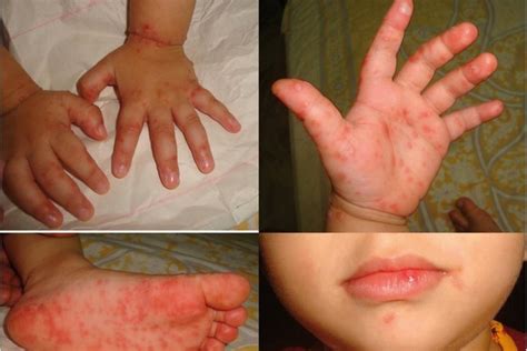 Pediatri che cos è la malattia mani piedi bocca Emergency Live
