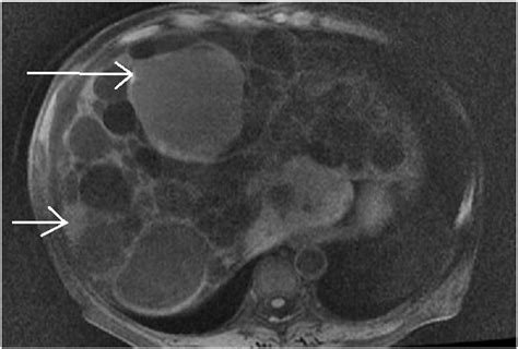 Complex Liver Cysts In Autosomal Dominant Polycystic Kidney Disease