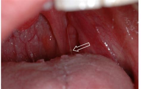 Mild Tonsil Stones