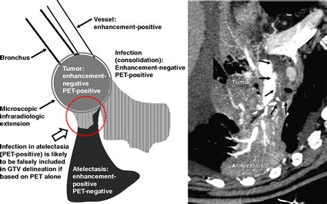 Value Of Combined Petcontrast Enhanced High Resolution Ct Fusion