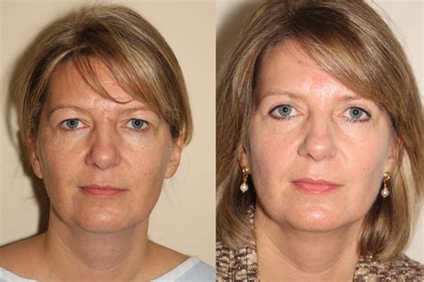 Upper Eyelid Surgery Before And After Upper Eyelid Surgery Vancouver