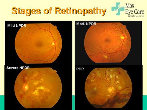 Stages Of Diabetic Retinopathy Rohan Chawla Flickr