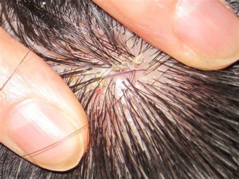 What is an itchy scalp? Natural and Alternative Treatments for Scalp Psoriasis ...