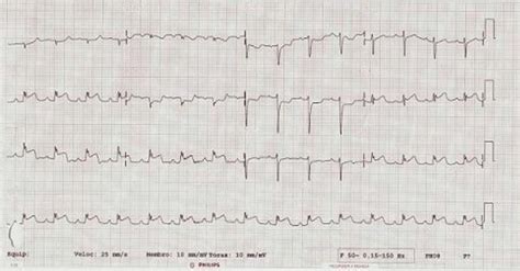 12 Lead Electrocardiogram With St Segment Elevation In Leads Ii Iii