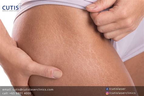 Whats The Difference Between Cellulite And Stretch Marks