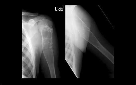 Lgh Med 5 Talk 3 Msk Overview043 001 Aneurysmal Bone Cys Flickr