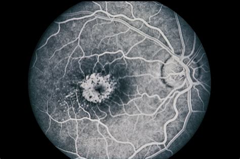 North Carolina Dystrophy Retina Image Bank