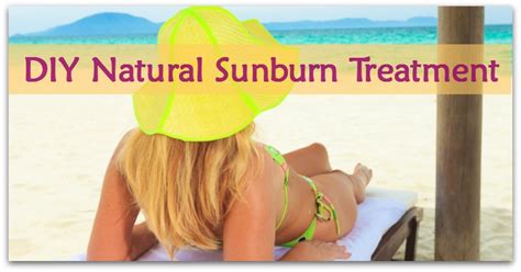 Diy Natural Sunburn Treatment Natural Holistic Life