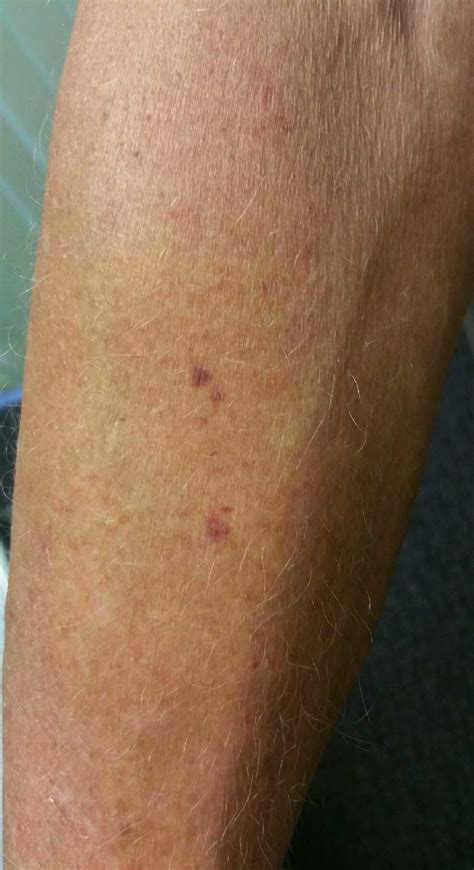 Spots On Arms That Look Like Bruises