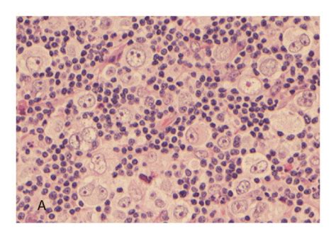 A And C Large Atypical Lymphoid Cells With One To More Nuclei