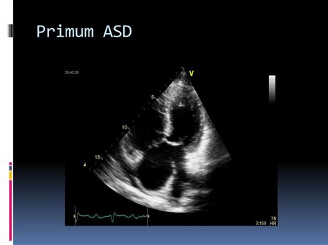 Ppt Atrial Septal Defects Powerpoint Presentation Free Download Id