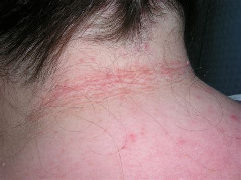 Acanthosis Nigricans The Clinical Advisor