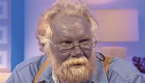 Knowing The Rather Weird Blue Skin Disorder Exhealth