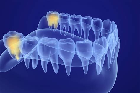 Wisdom Teeth Coming In Symptoms Boston Dentist Congress Dental