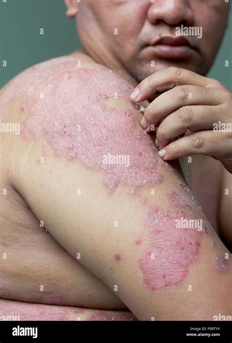People With Psoriasis Look At Their Arms Full Of Wounds And Scratches