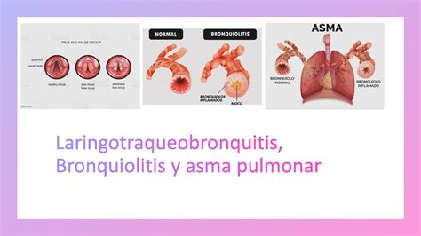 Solution Laringotraqueobronquitis Bronquiolitis Y Asma Pulmonar