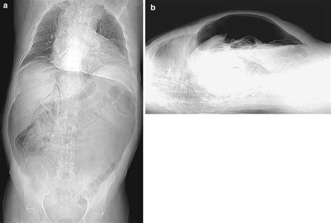 Pneumoretroperitoneum Imaging Findings Radiology Key