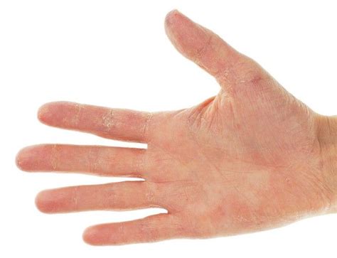 Exfoliative Keratolysis Cracked Fingertips Skin Peeling On Hands