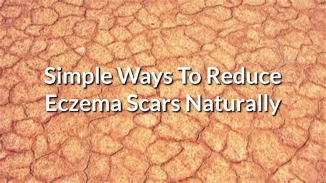 Recommended by doctors · clinically proven · made in the usa How To Get Rid Of Eczema Scars/ Eczema Scars Treatment At ...