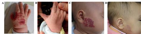 Clinical Efficacy Of Propranolol In The Treatment Of Hemangioma And