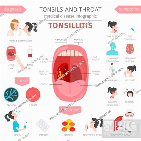 Tonsils And Throat Diseases Tonsillitis Symptoms Treatment Icon Set