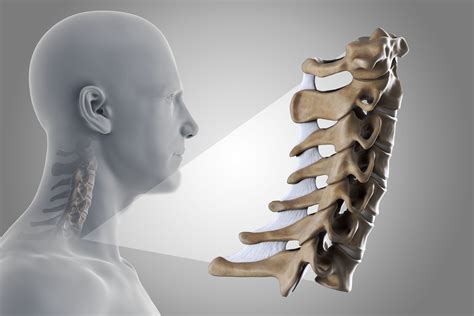 Should You Have Surgery For Cervical Radiculopathy