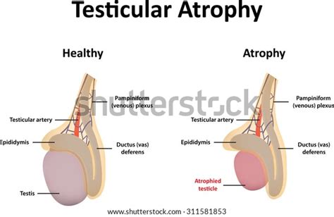 Testicular Atrophy Stock Vector Royalty Free Shutterstock